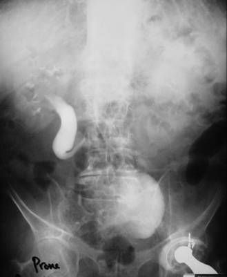 Retrocaval Ureter